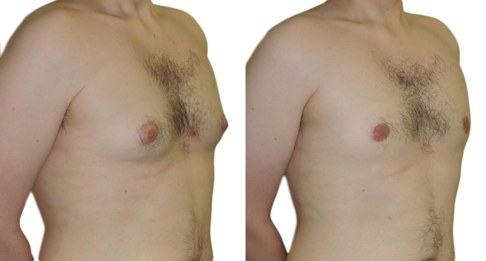 Male Breast Reduction