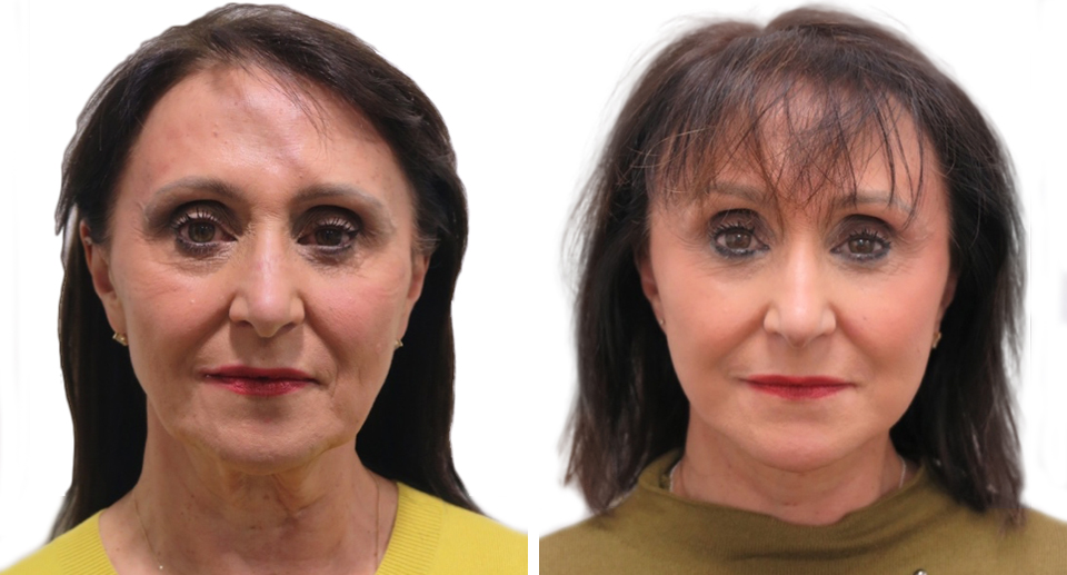 Facelift / Necklift