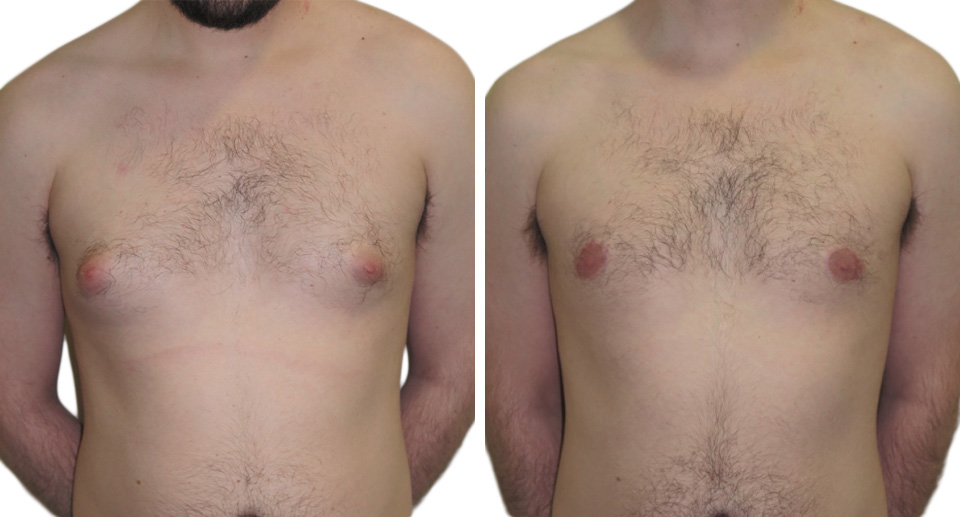 Male Breast Reduction