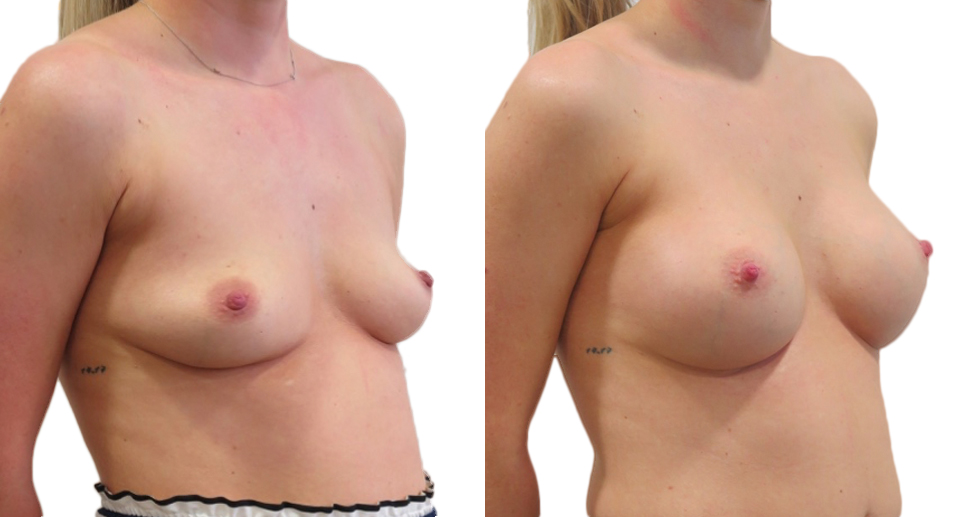 Breast Enlargement