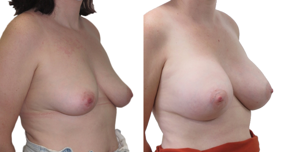 Breast Enlargement