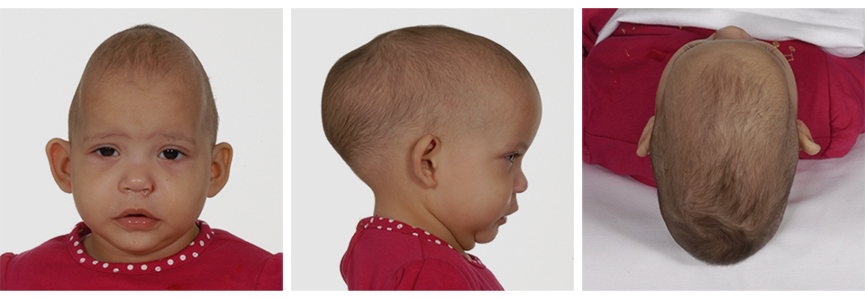 Sagittal Craniosynostosis Adults