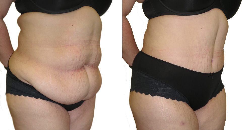 Tummy Tuck