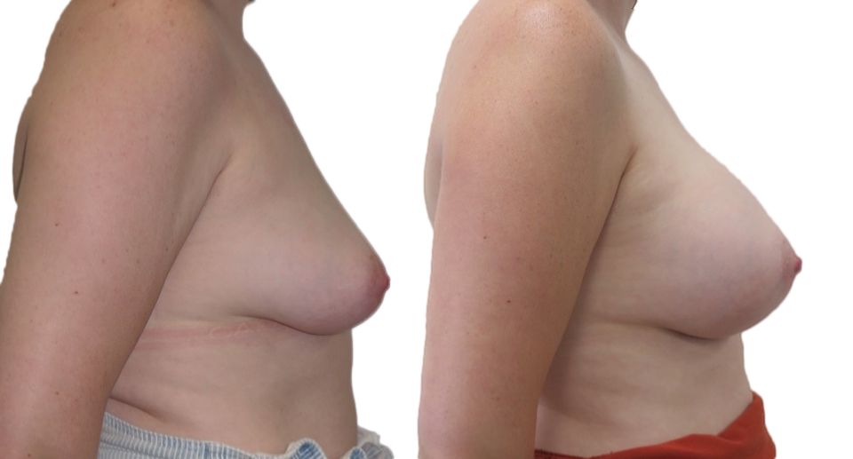 Breast Enlargement