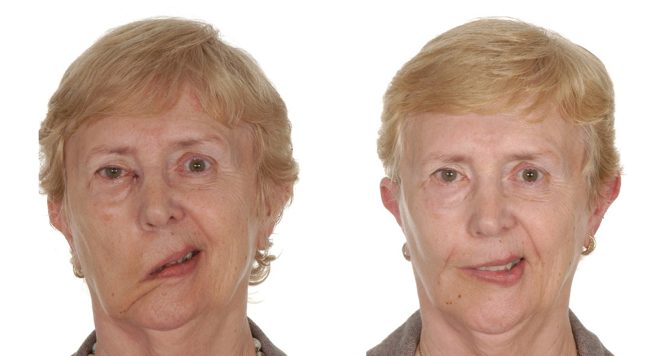 Surgery and Anti-wrinkle Injections for Facial Palsy