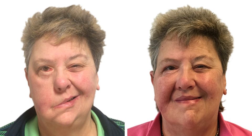 Surgery and Anti-wrinkle Injections for Facial Palsy