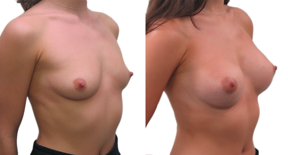 Breast Enlargement