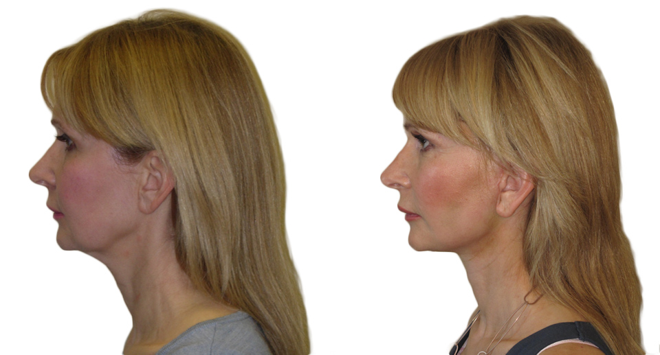 Facelift / Necklift