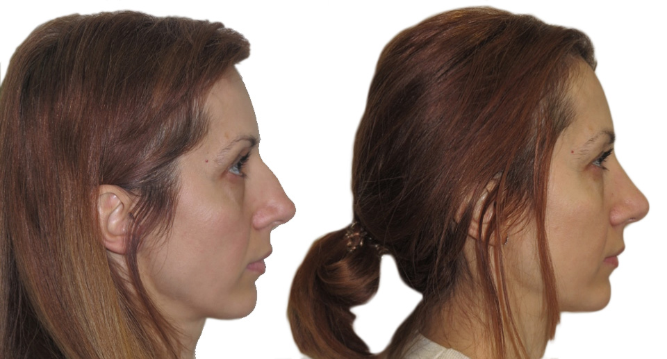 Nose Reshaping