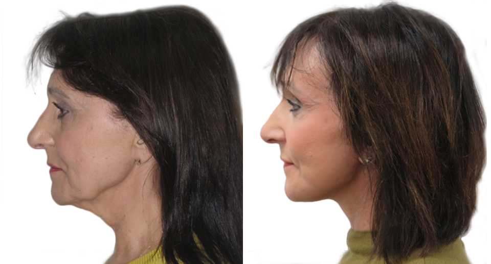 Facelift / Necklift